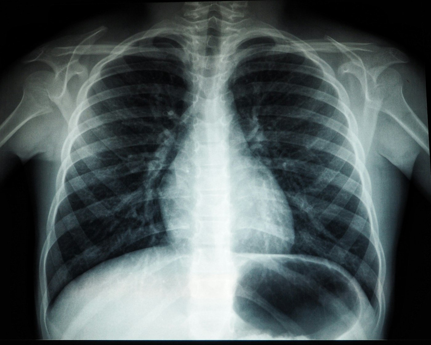 Radiografía de tórax, imagen ilustrativa sobre estudios pulmonares